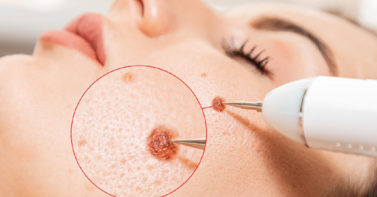 A Women Receiving Electrocautery Treatment in Allen, TX